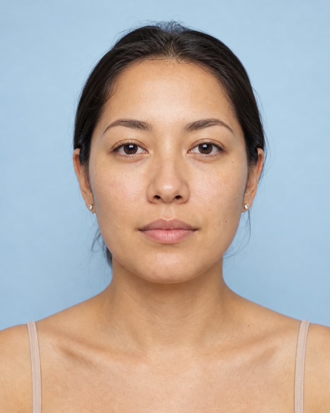 Synthetic portrait demonstrating a subtle illustrative lip filler simulation, source portrait