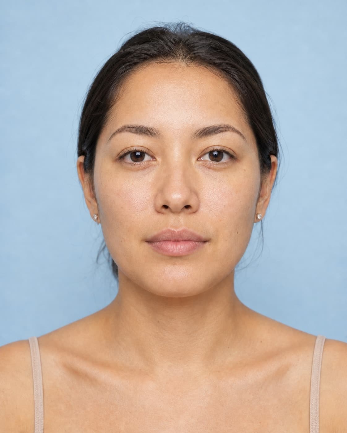 Synthetic portrait demonstrating a subtle illustrative lip filler simulation, simulated preview